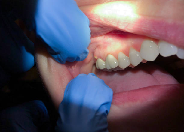 Best Teeth Whitening  in Arcadia, LA